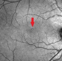 Laser pointer maculopathy