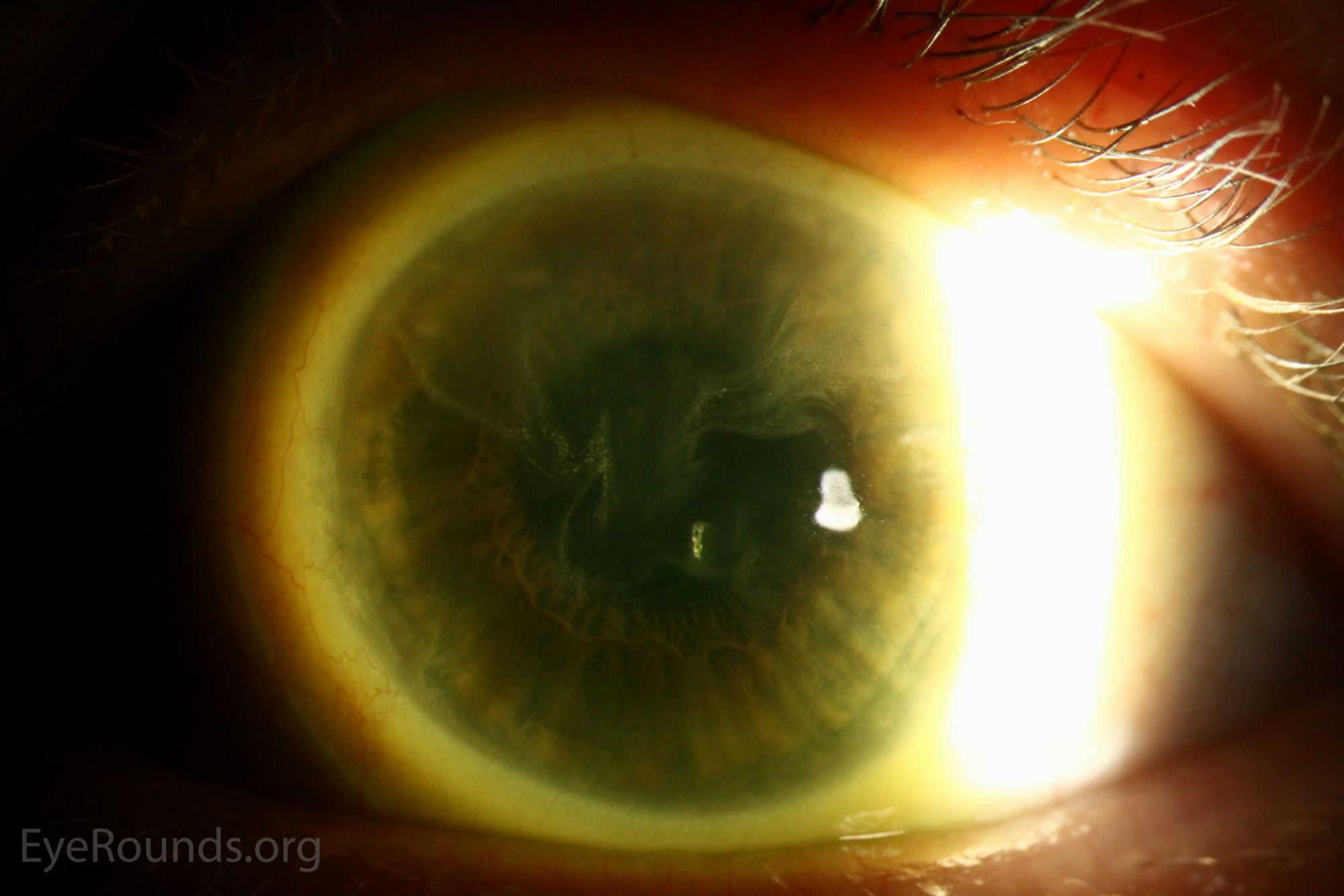 Disruption of the normal physiologic regenerative process and repopulation of corneal epithelium