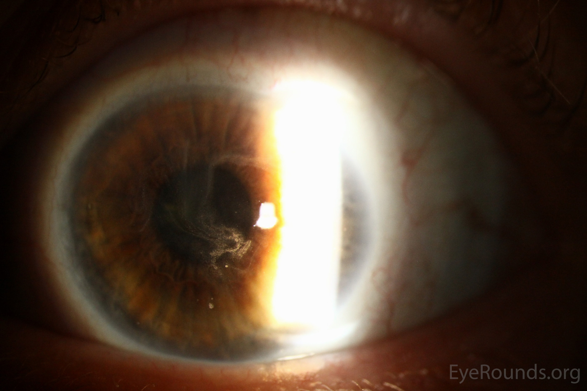Slit Lamp -  disruption of the normal physiologic regenerative process and repopulation of corneal epithelium