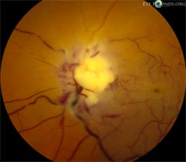 Lymphomatous infiltration of left optic nerve with central retinal artery occlusion