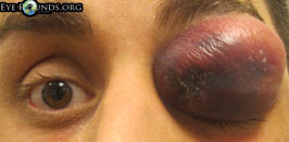 Methicillin-resistant Staphylococcus aureus (MRSA) preseptal cellulitis