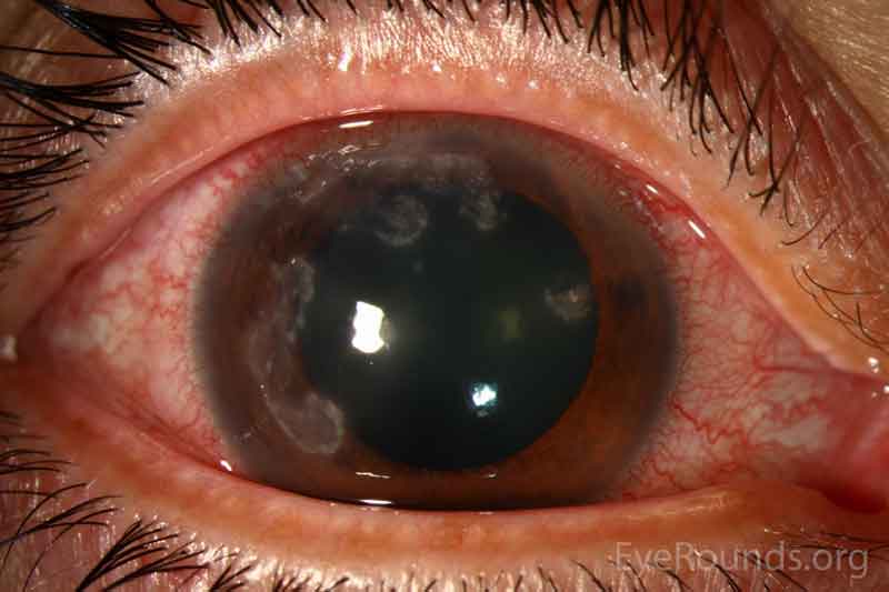 Figure 1. Slit lamp photography of the right eye. This photograph demonstrates multifocal stromal infiltrates in the mid-periphery extending along the limbus. There is prominent ciliary flush, diffuse conjunctival injection, and a superior pannus. 