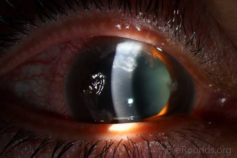 Figure 2. Slit lamp photography of the right eye. This photograph shows a moderate amount of white blood cell recruitment surrounding the stromal opacities in addition to small, branching-type lesions extending from the stromal opacities. Several satellite lesions are present. 