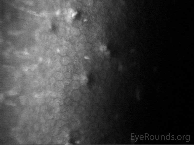 Figure 4. Confocal microscopy: endothelium with evidence of mild polymegathism, which is a sign of corneal stress.
