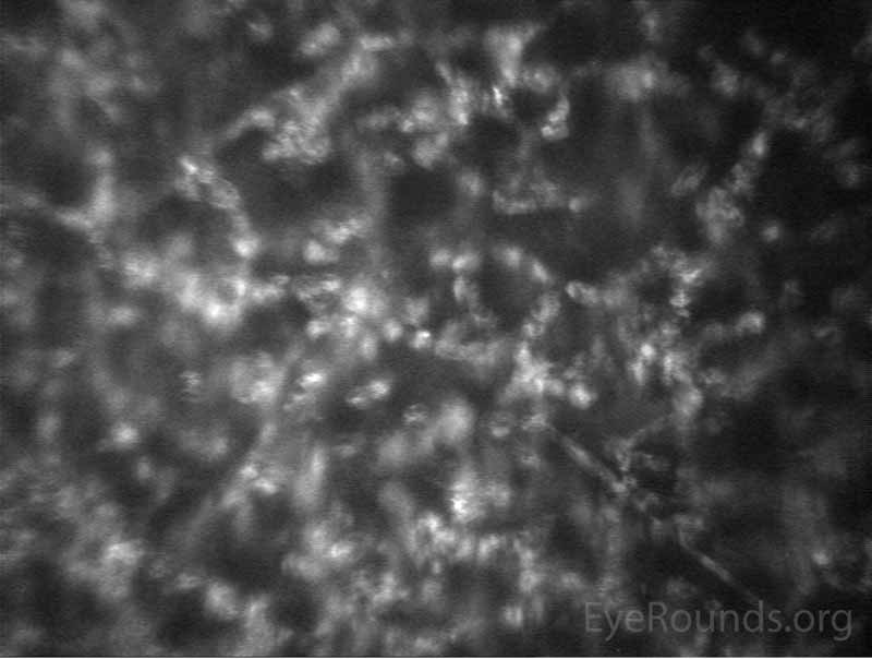 Figure 4. Confocal microscopy: numerous activated keratocytes (bright figures), which are seen in diffuse keratitis.