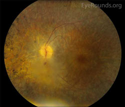 noncalcified astrocytic hamartoma in the setting of retinitis pigmentosa