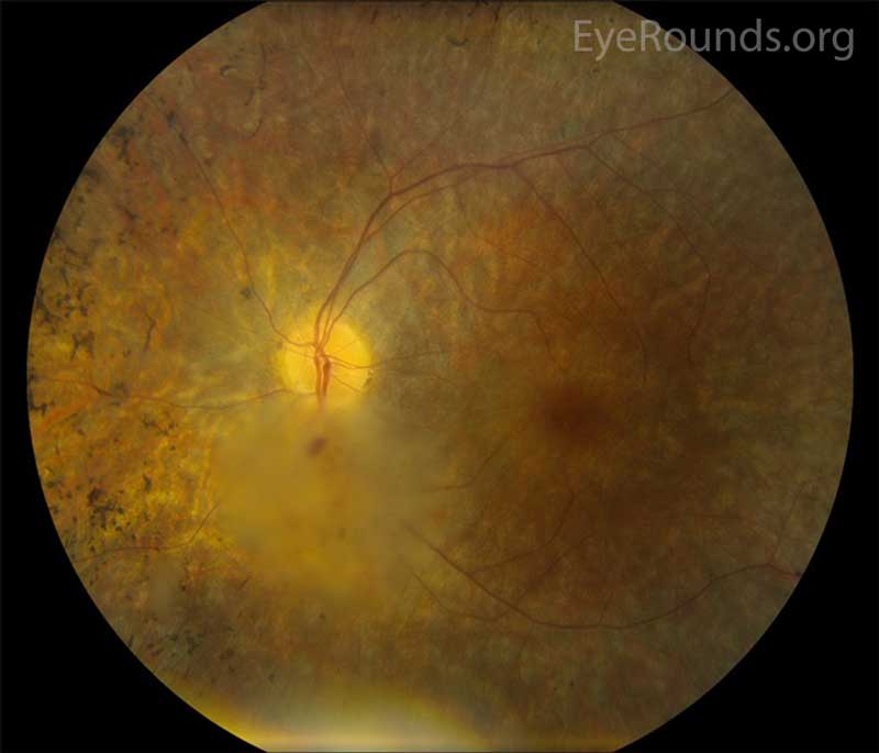Fundus Noncalcified Astrocytic Hamartoma in the setting of Retinitis Pigmentosa