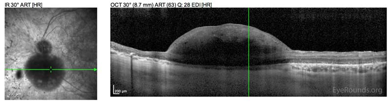 OCT Noncalcified Astrocytic Hamartoma in the setting of Retinitis Pigmentosa