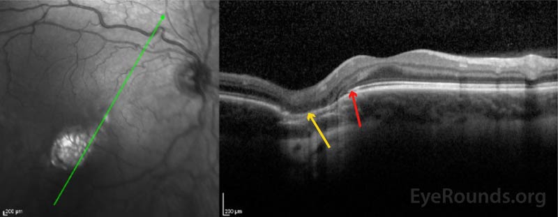 OCT with radial raster through the lesion demonstrating thinned RPE (gold arrow), loss of the inner/outer segment of the photoreceptors (transition point labelled with red arrow).