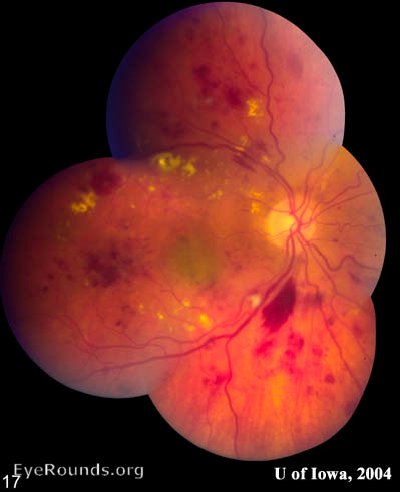 Accelerated Hypertension with hypertensive retinopathy
