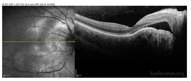 OCT Tuberous Sclerosis with Optic Nerve Hamartoma