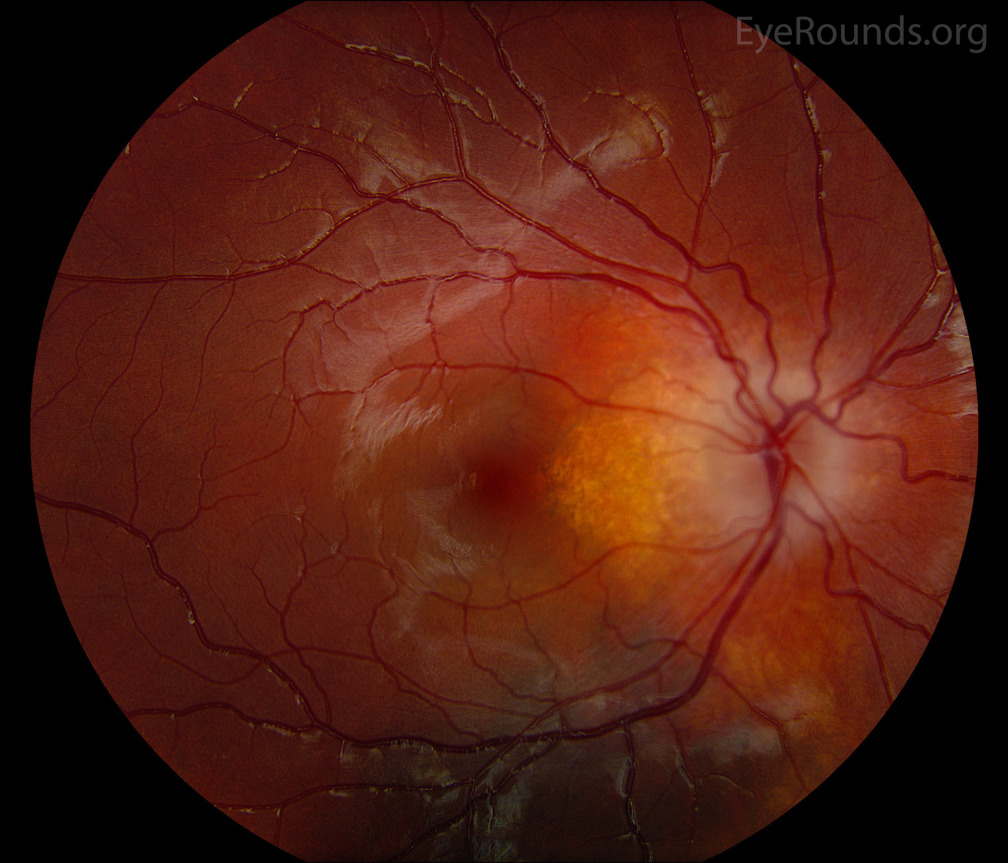 Fundus Tuberous Sclerosis with Optic Nerve Hamartoma OD