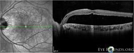 Optic nerve pit maculopathy