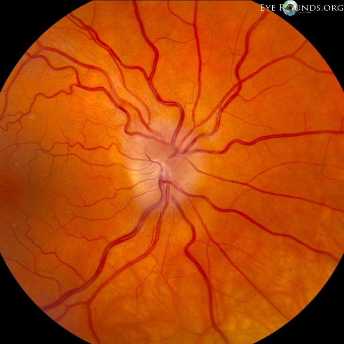 Dilated funduscopic demonstrates mild chronic appearing disc edema and dilated veins in the right eye