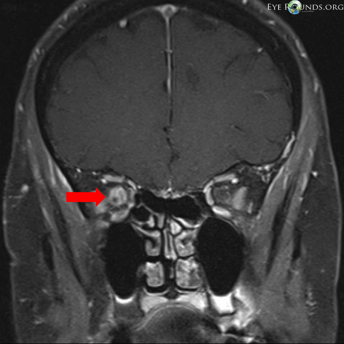 nerve sheath meningoma MRI