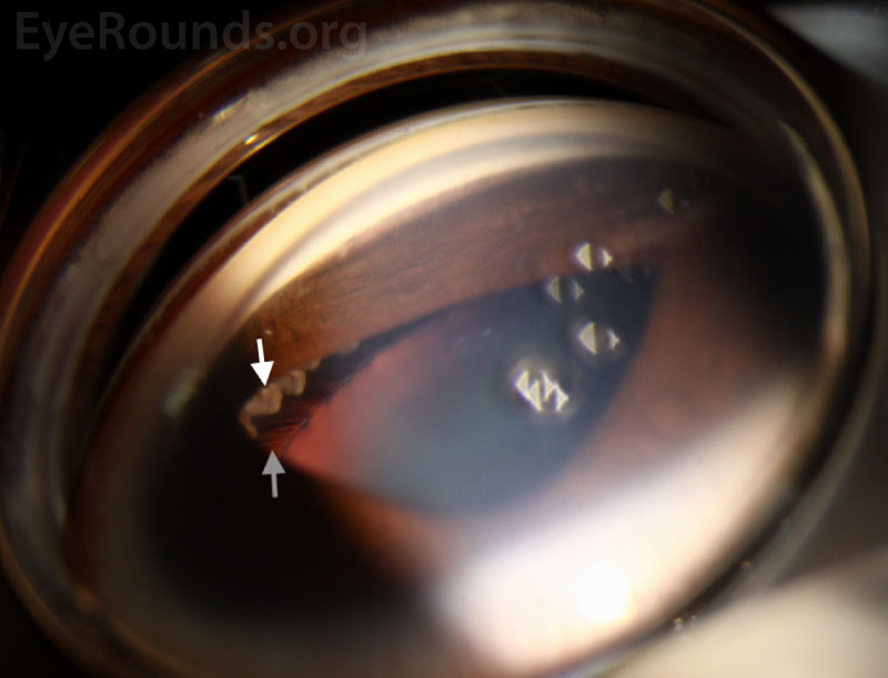  Gonioscopic photography of the right eye provides a unique view of the ciliary processes (white arrow) and zonules of the crystalline lens