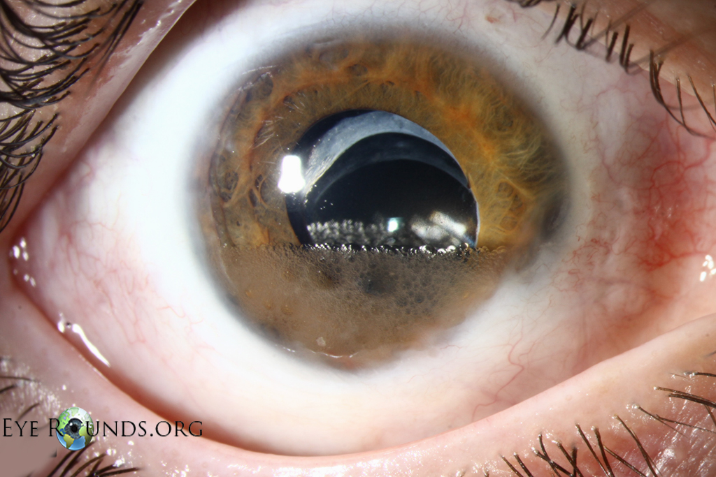 large amount of PFCL in the anterior chamber.