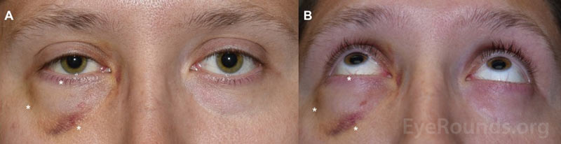External photographs in frontal view (A) and worm's eye view (B) showing fullness in the area correlating with crepitus on examination (asterisks).