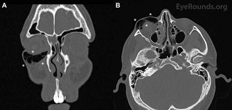 Coronal (A) and axial (B) computed tomography images of the head show the presence of subcutaneous air (asterisks).