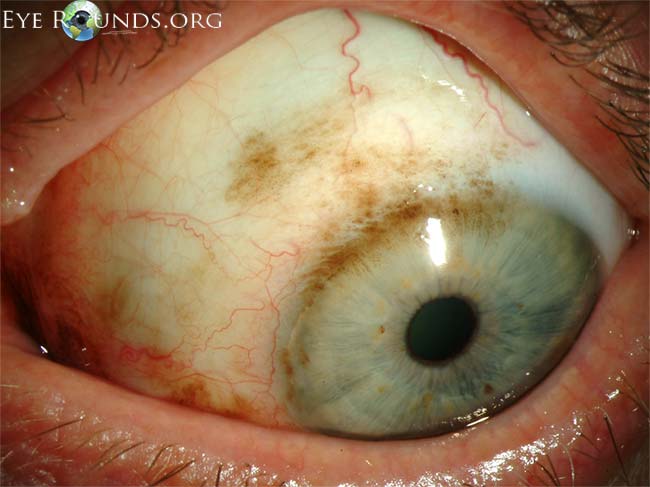 Primary acquired melanosis (PAM) is an acquired pigmentation of the conjunctival epithelium