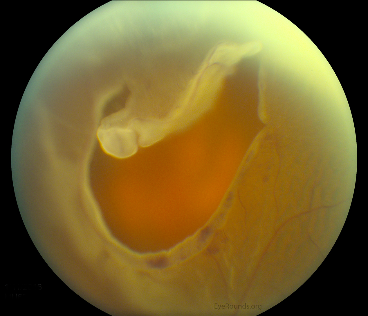 large, superior horseshoe tear with a bullous retinal detachment