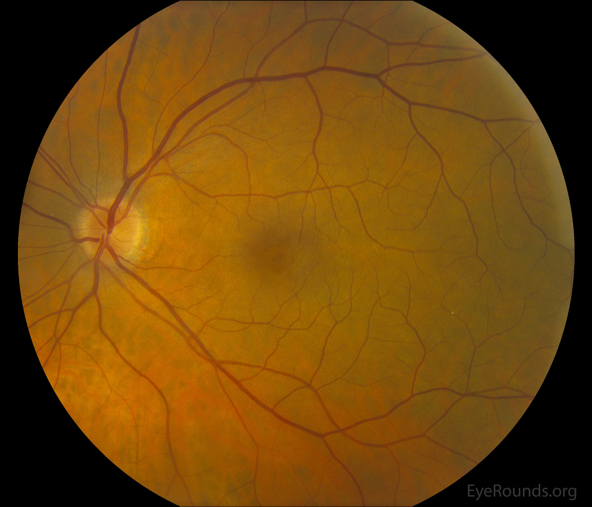 macular hole, an incidental yellow-orange plaque was visible within a vessel of the inferotemporal arcades within the inferotemporal macula