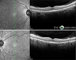 Retinitis pigmentosa sine pigmento