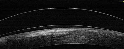 Scleral lens touch
