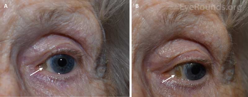 External photographs demonstrating a senile calcific plaque (arrows) found nasally in an 88-year-old woman and visible in primary (A) and lateral (B) gazes.