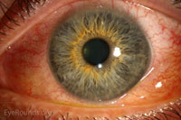 Bilateral Chemosis in Thyroid Eye Disease
