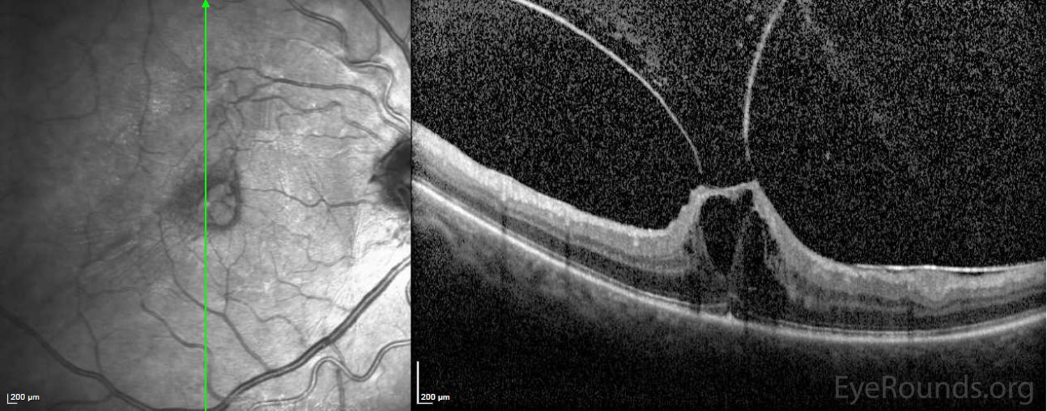 OCT showing Vitreomacular tractionwith associated macular edema