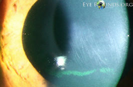 Vogt's striae in keratoconus
