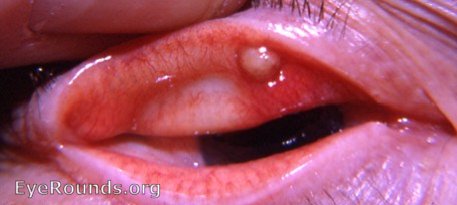 abscess of meibomian gland