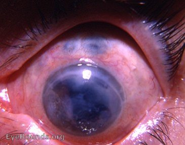 absolute glaucoma, failed iridencleisis, and tattooed cornea