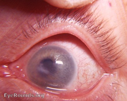 adherent leukoma due to perforating corneal injury to only eye