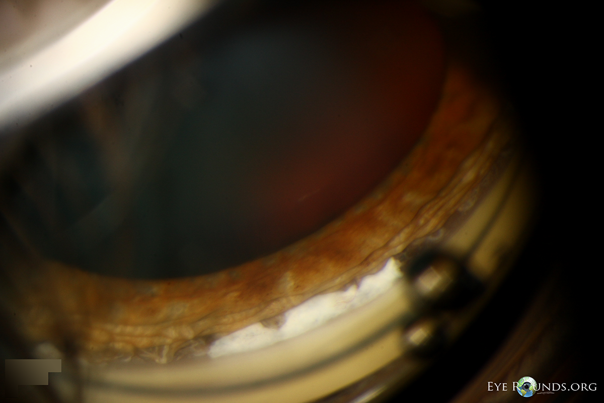 Gonioscopy image of raquetball injury to eye