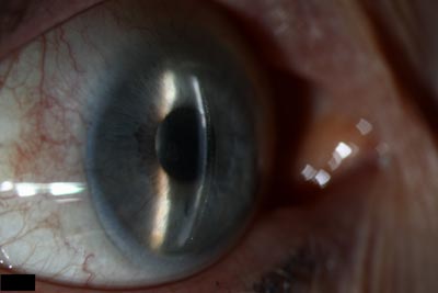 Appropriate scleral lens sagittal depth