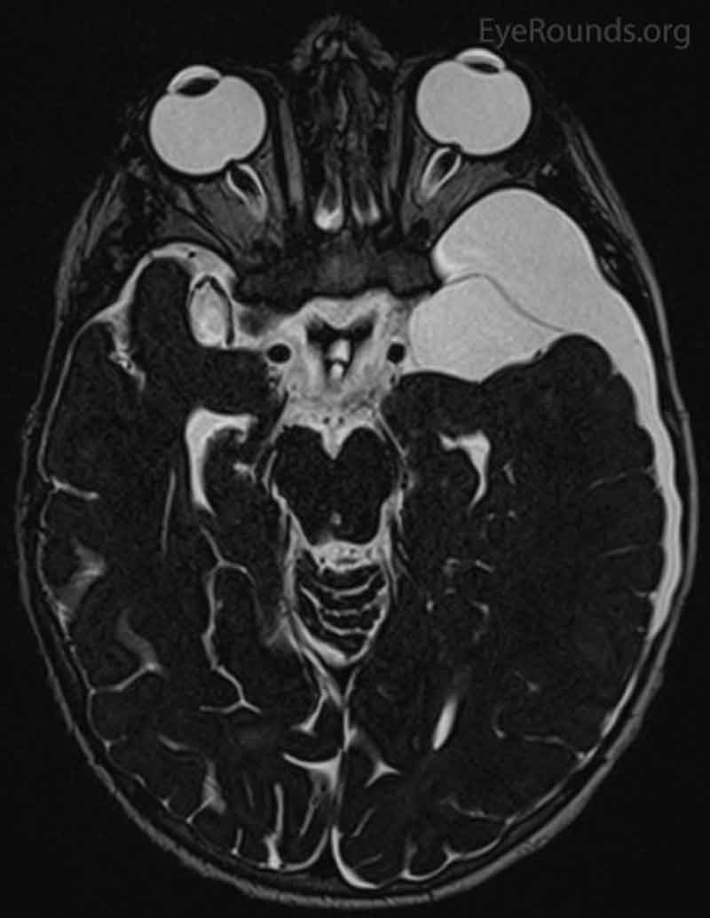 bilateral-cranial-nerve-vi-palsies-secondary-to-arachnoid-cyst