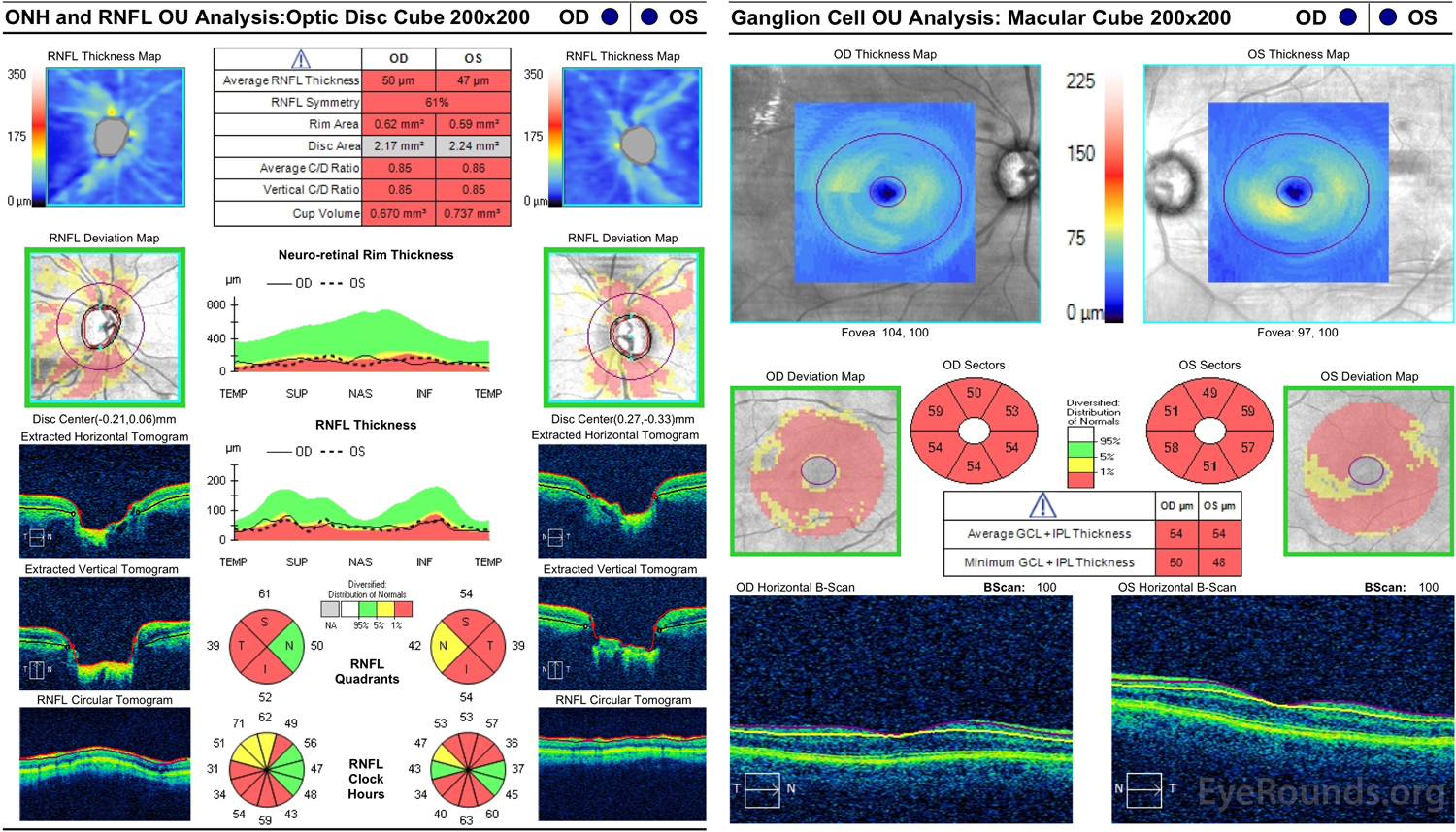 Optical coherence tomography analysis of optic nerve head (ONH), retinal nerve fiber layer (RNFL), and ganglion cell layer fiber layer of both eyes