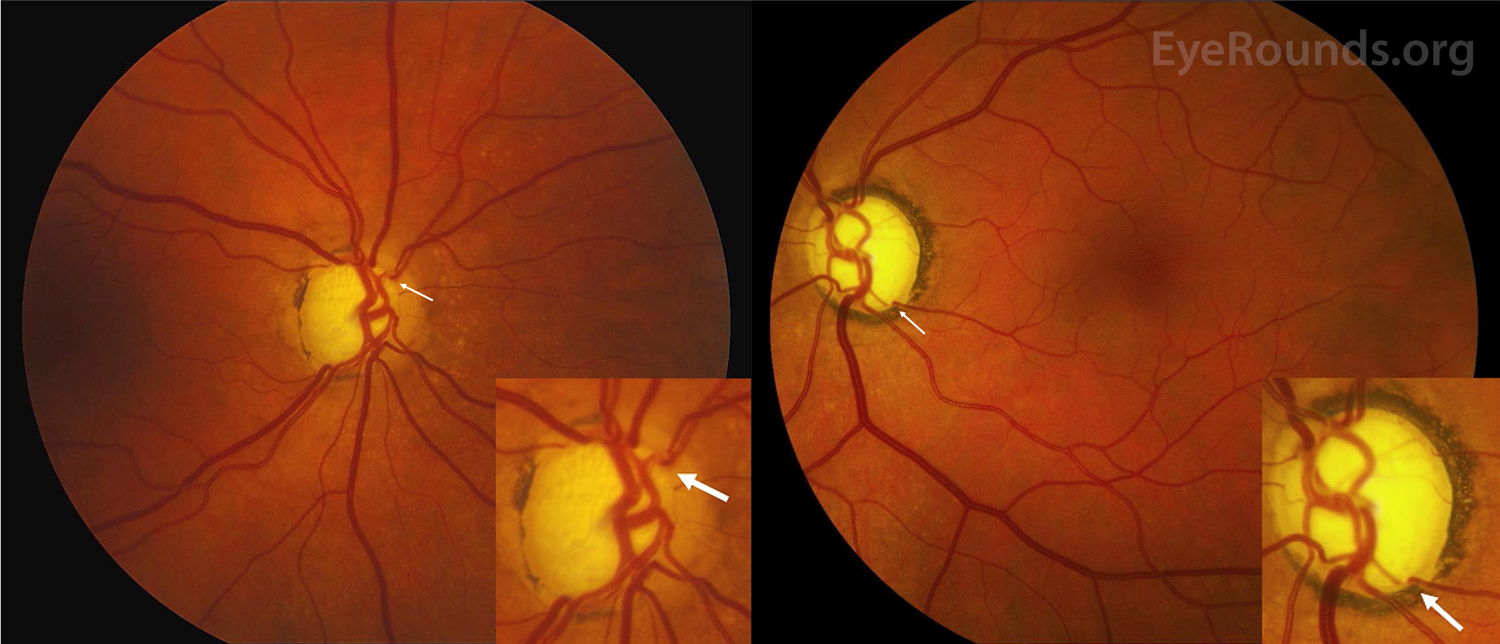 Color fundus of both eyes, severe open-angle glaucoma.
