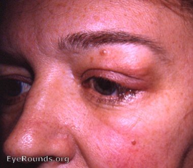benign lymphocytic infiltration - lacrimal gland - OS