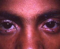 lids: blepharitis marginalis - a typical case as seen in the USA