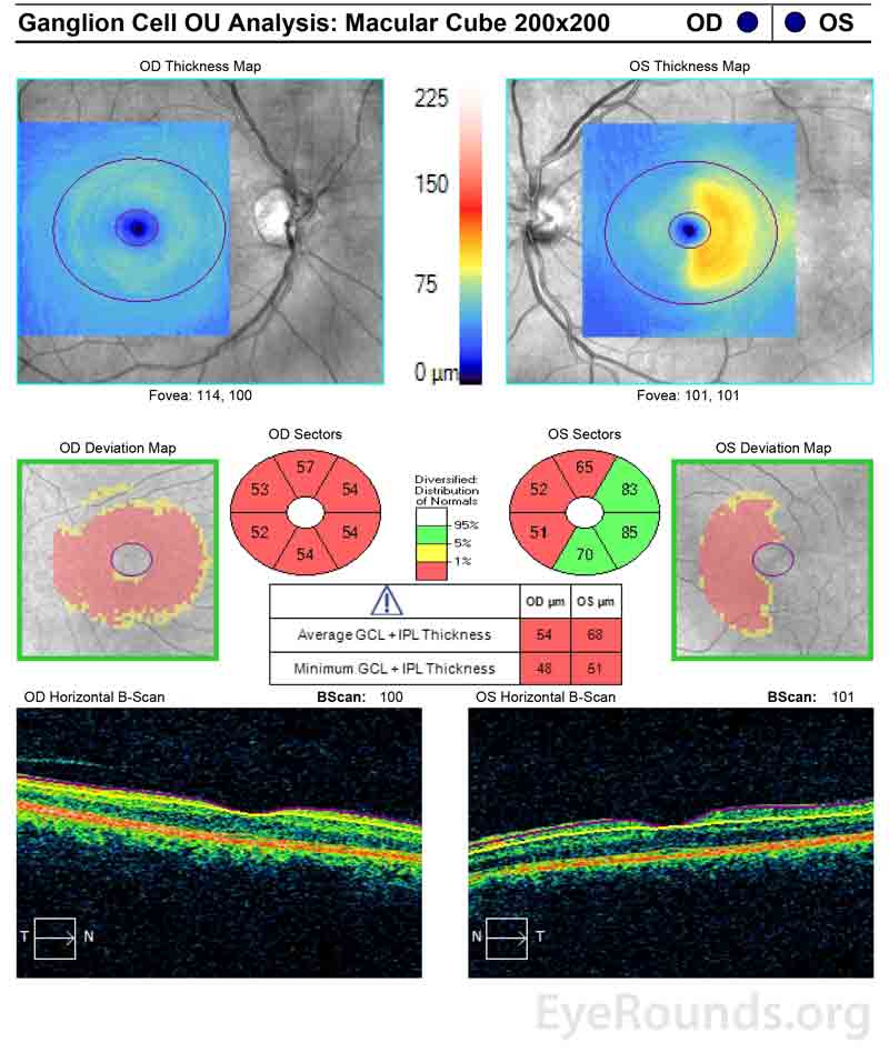 vOcular coherence tomography of the macula showed diffuse ganglion cell layer (GCL) thinning OD and nasal GCL thinning OS
