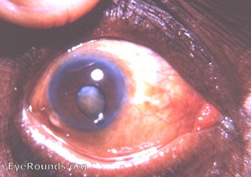 Coloboma of iris - a special bridge variety-with a mature corticonuclear cataract