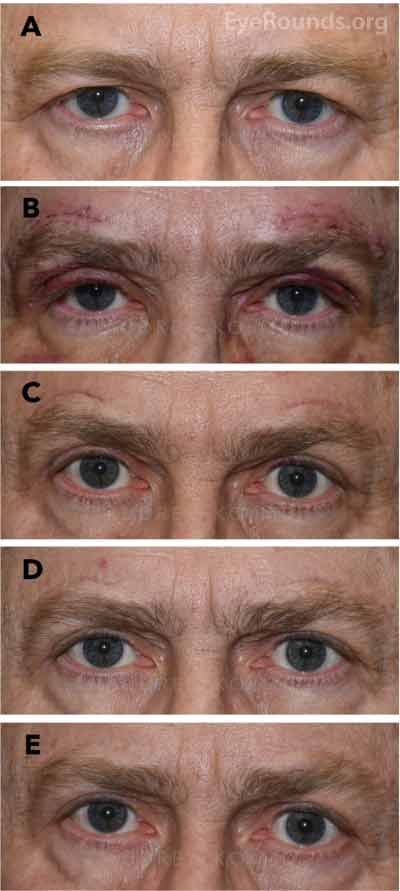 demonstrates the progression of the brow scar appearance in a male patient who underwent a direct browplasty.  His preoperative appearance is notable for brow ptosis and upper eyelid dermatochalasis (Figure 1A).  The scars above the brows are very red and prominent 1 week after surgery (Figure 1B) and continue to have a very red and obvious appearance 1 month after surgery (Figure 1C).  Approximately 3 months after surgery, the scar is no longer red, but it is still visible as a linear depression in the skin (Figure 1D).  The scars are barely visible 1 year after surgery (Figure 1E).