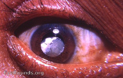 cataracta calcarea - a subluxated calcified cataract