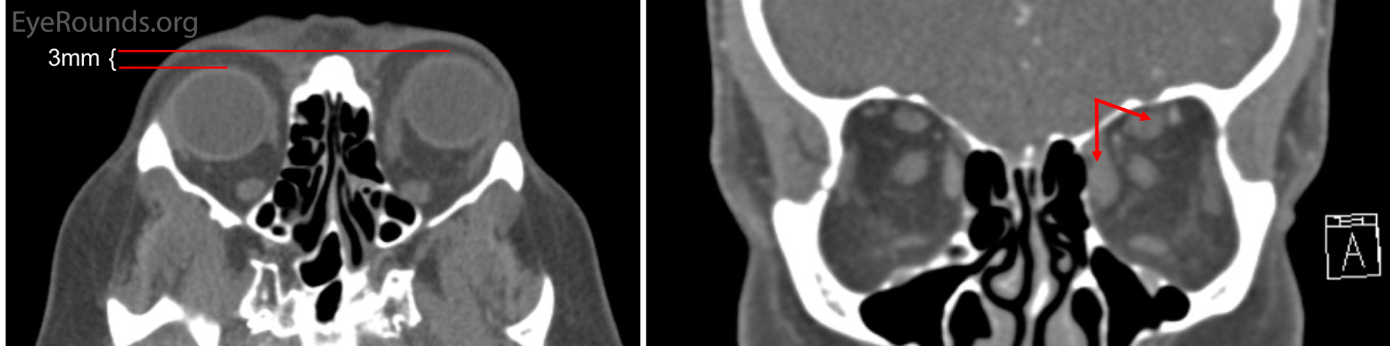 Pre-operative CT imaging of the orbits.