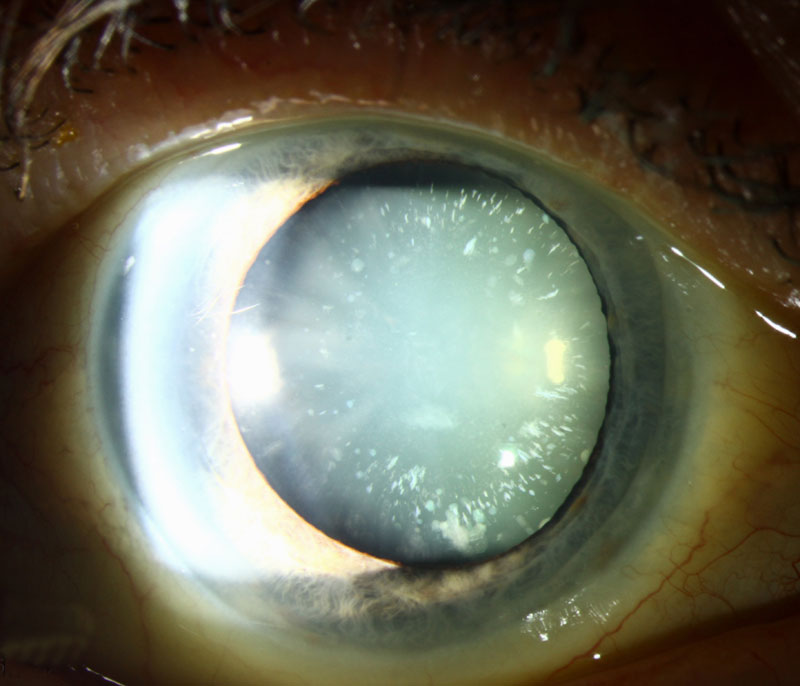 Cerulean cataract looking imagine the blue color on tarnished copper