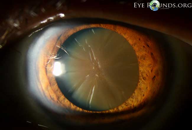Brunescent cataract