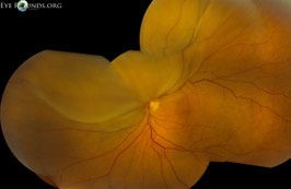 Choroidal Lymphoma Causing Exudative Retinal Detachment